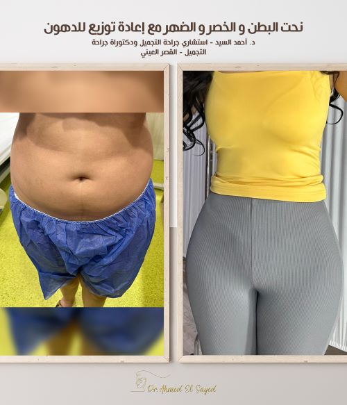 نتائج نحت البطن والخصر